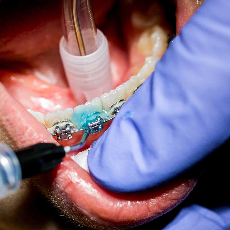 photoraphe reportage sante medical marseille Photo santé Marseille : gros plan de la pose d'un appareil dentaire par un orthodontiste avec des gants bleus de protection.